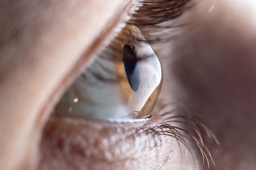 Cirugía refractiva para astigmatismo