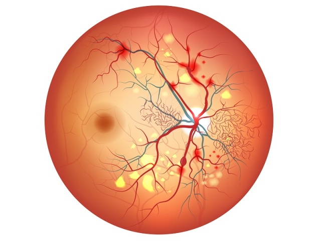 retinopatia-diabetica-tratamiento